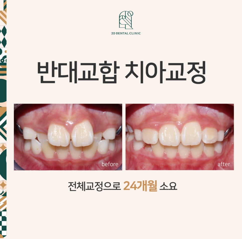 어린이 반대교합 덧니 교정으로 교정 끝! by. 투디치과(2D치과) 관련 이미지 1