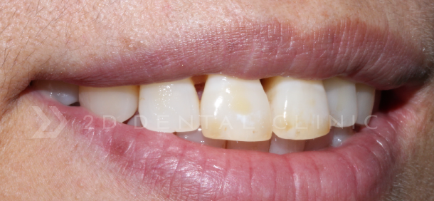 블랙트라이앵글 치아사이틈 개선은 무삭제라미네이트 블랙필름 관련 이미지 2