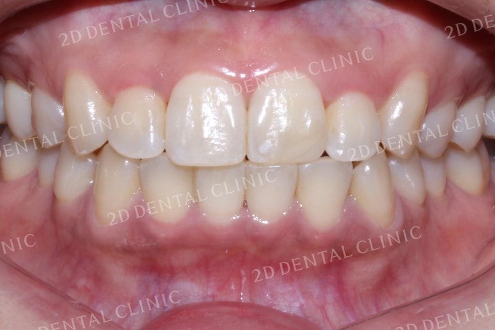 반대교합으로 물리는 치아를 바른 교합으로 교정하기! by.투디치과(2D치과) 관련 이미지 13