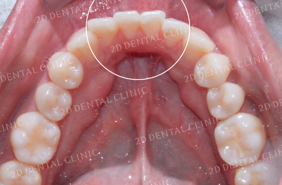 비대칭 앞니, 돌출앞니를 전체 교정으로 교정하고 싶다면!? by.투디치과(2D치과) 관련 이미지 6