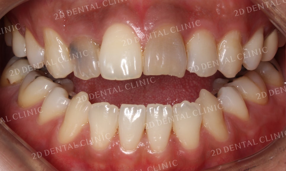 치아변색, 까맣게 변한 변색치를 블링스(Blinx)로 수복하기! by. 투디치과(2D치과) 관련 이미지 10