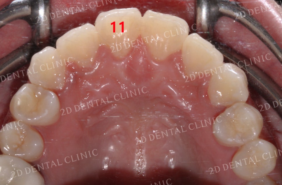 돌출입, 돌출앞니를 부분교정으로 고르게! by.투디치과(2D치과) 관련 이미지 13