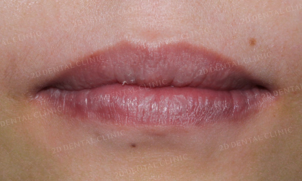 [2D교정] 나비치아, 앞니교정 설측교정으로 빠르게 하는 방법! by.2D치과(투디치과) 관련 이미지 8