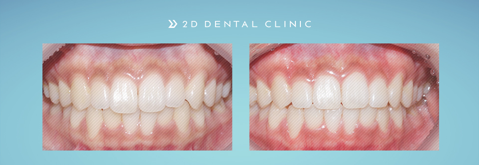 케이스로 확인하는 토끼이빨, 교정전문 2D치과 관련 이미지 1