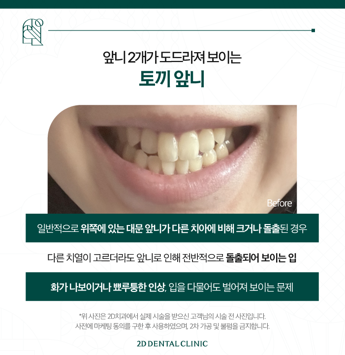 무삭제라미네이트가격 토끼 앞니도 개선이 되나요? 관련 이미지 3