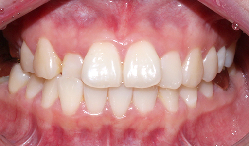 덧니치아 2D교정으로 4개월만에 교정 끝! by.투디치과(2D치과) 관련 이미지 16