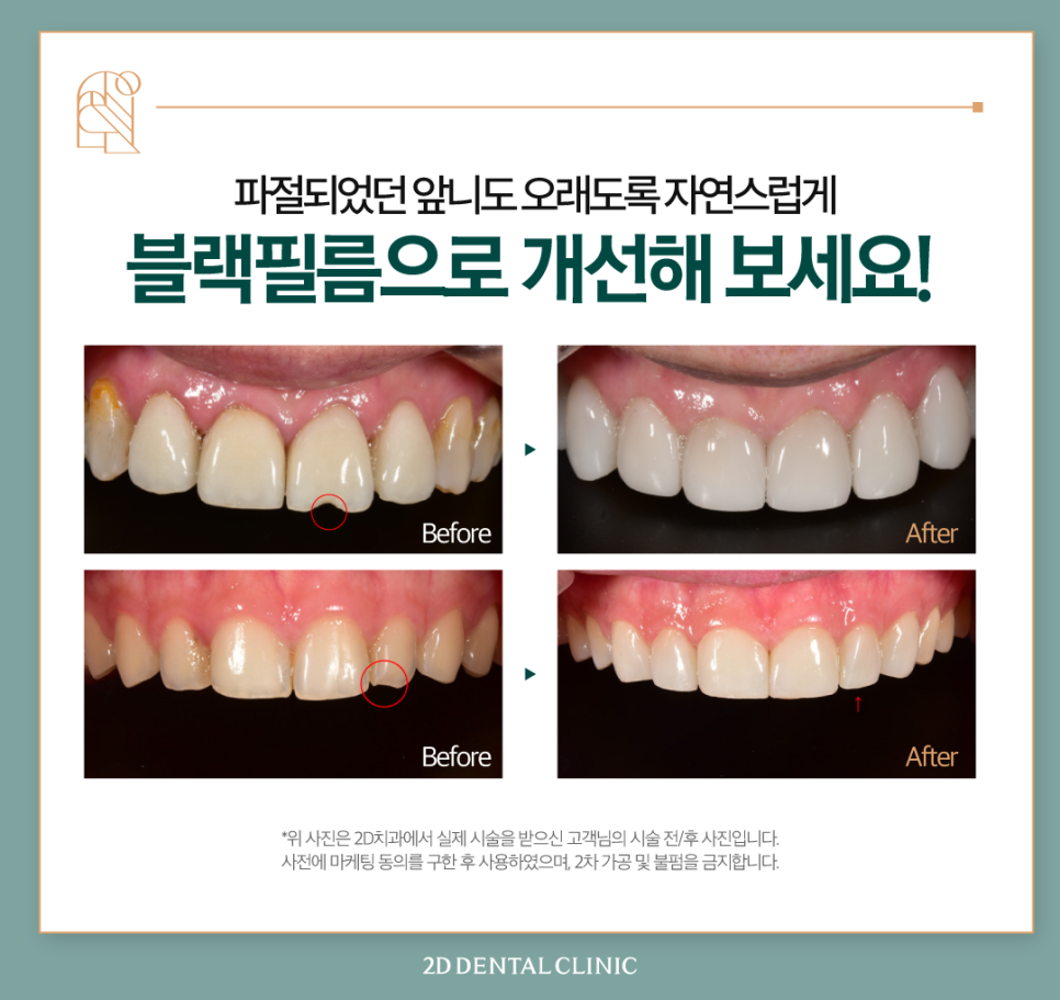 강남역치과 치아끝깨짐 첫인상을 좌우하는 요인! 관련 이미지 7