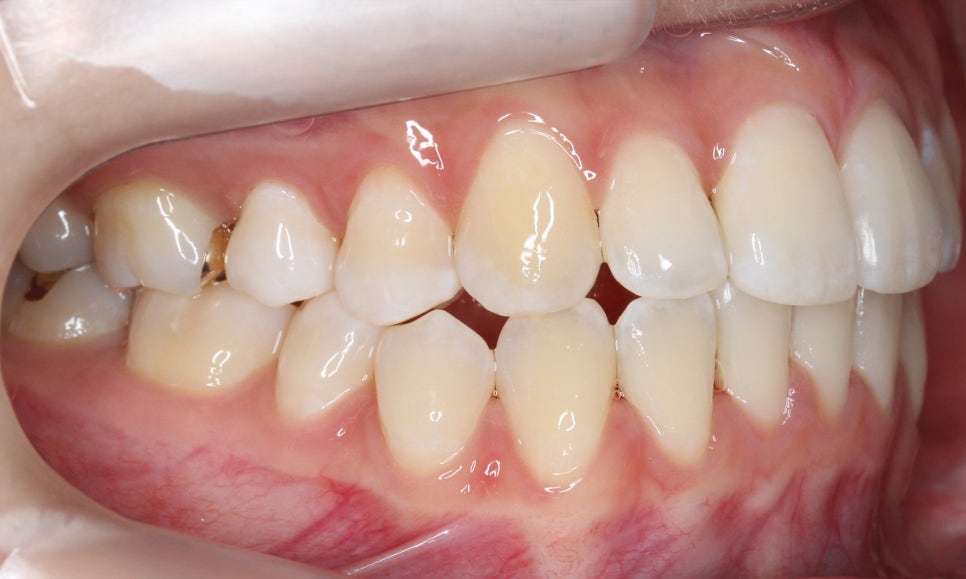 신논현치과 자가결찰브라켓 장점 관련 이미지 13