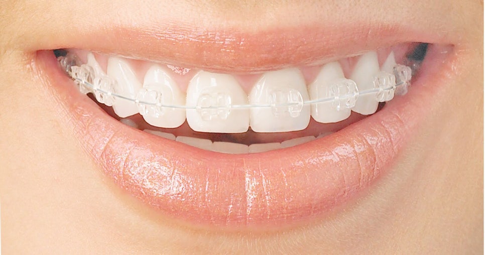 극강심미성추구[투디치과]화이트와이어(white wire) 관련 이미지 2