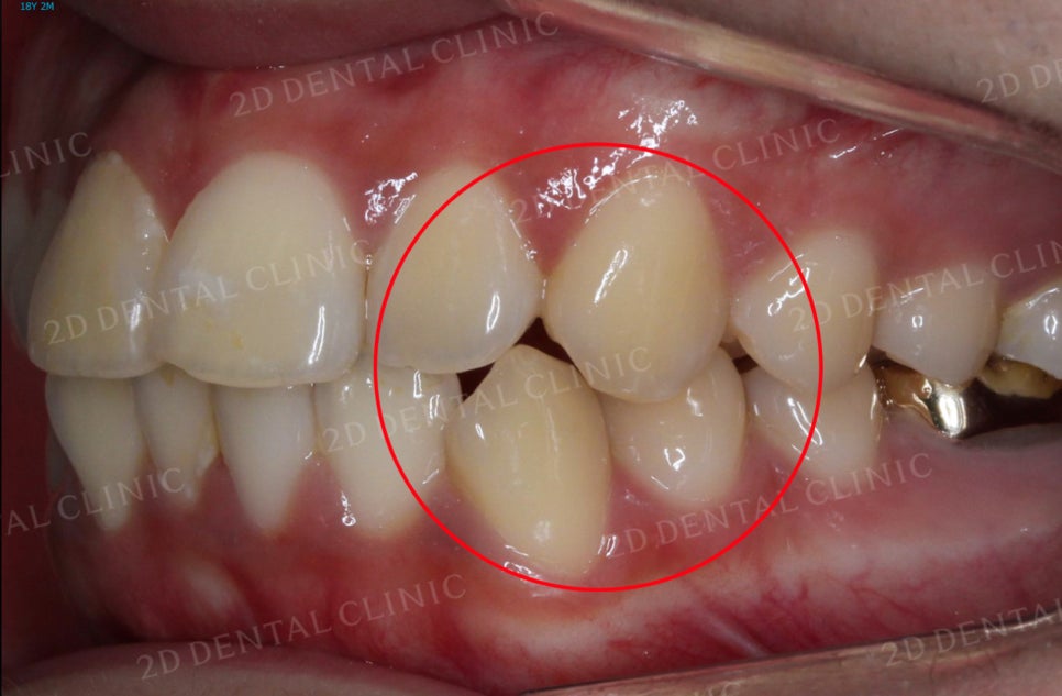 [앞니교정] 토끼앞니교정, 클리피씨 교정으로 완벽하게! by.투디치과(2D치과) 관련 이미지 5