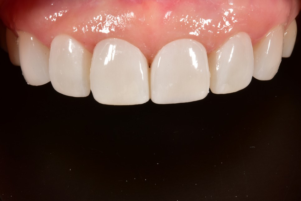 [투디치과] 블랙필름(비스포크) 치료의 다양한 사례 관련 이미지 28