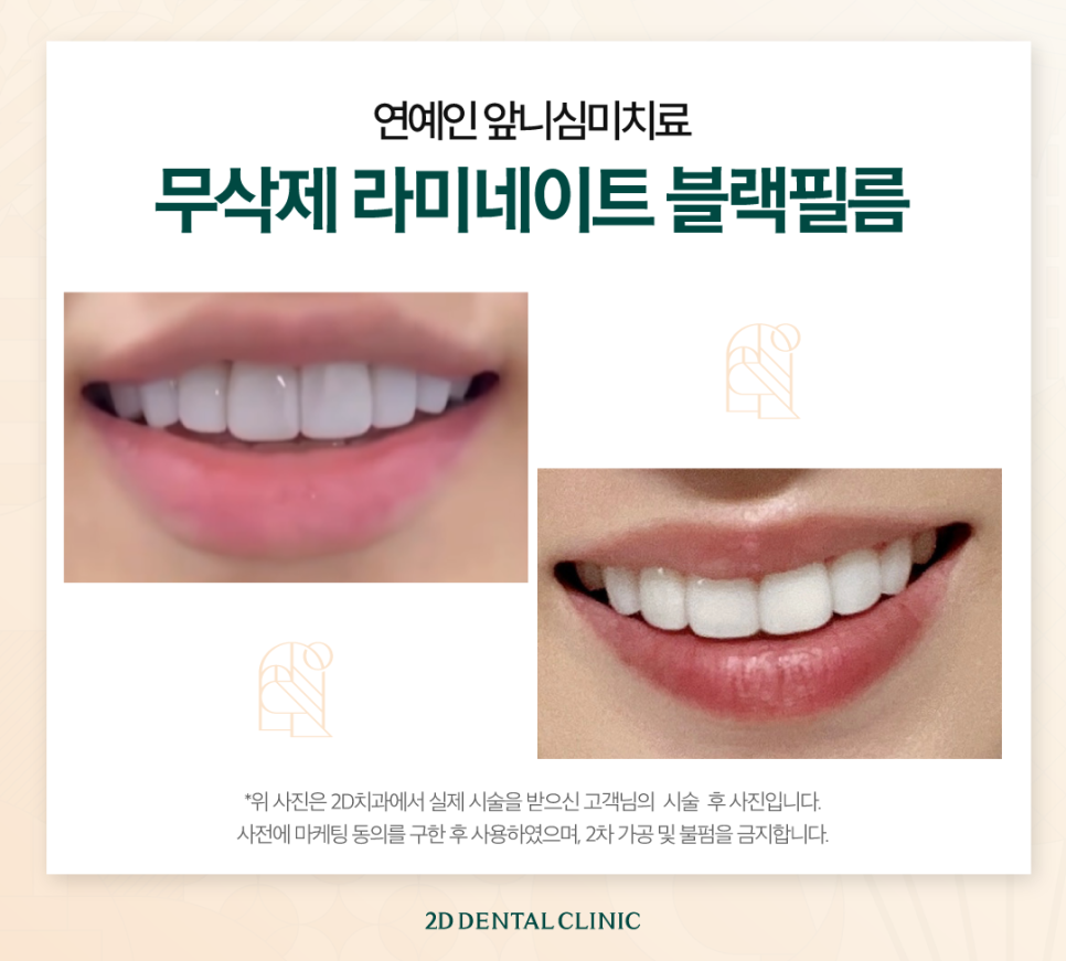 광주무삭제라미네이트 앞니심미치료 깔끔한 치아가 그저 부러웠다면 관련 이미지 6