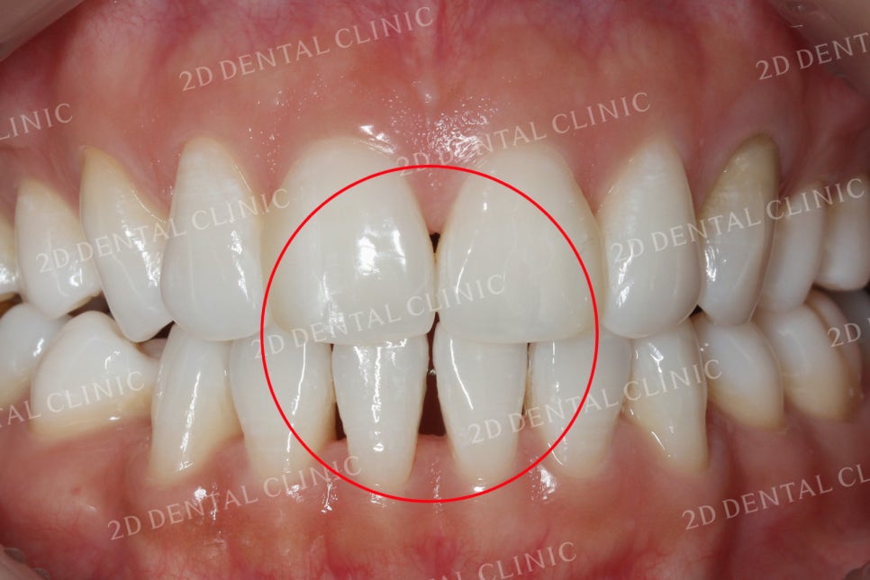 치아틈새를 완벽하게 메꾸자! 블랙트라이앵글 쎄라필름으로 완전 삭제! by.투디치과(2D치과) 관련 이미지 9