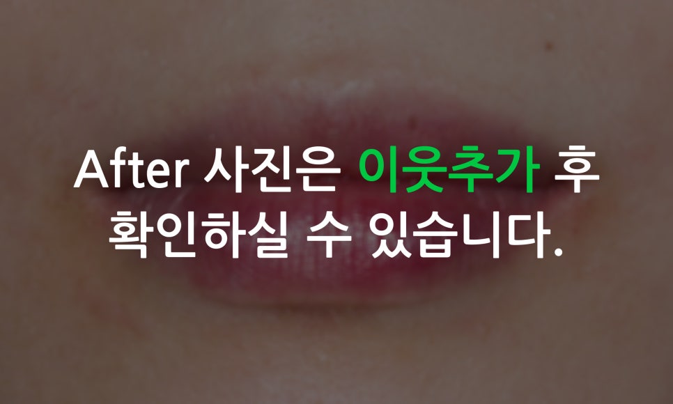 앞니틀어짐 2D교정으로 한번에 끝내는 방법! 관련 이미지 9