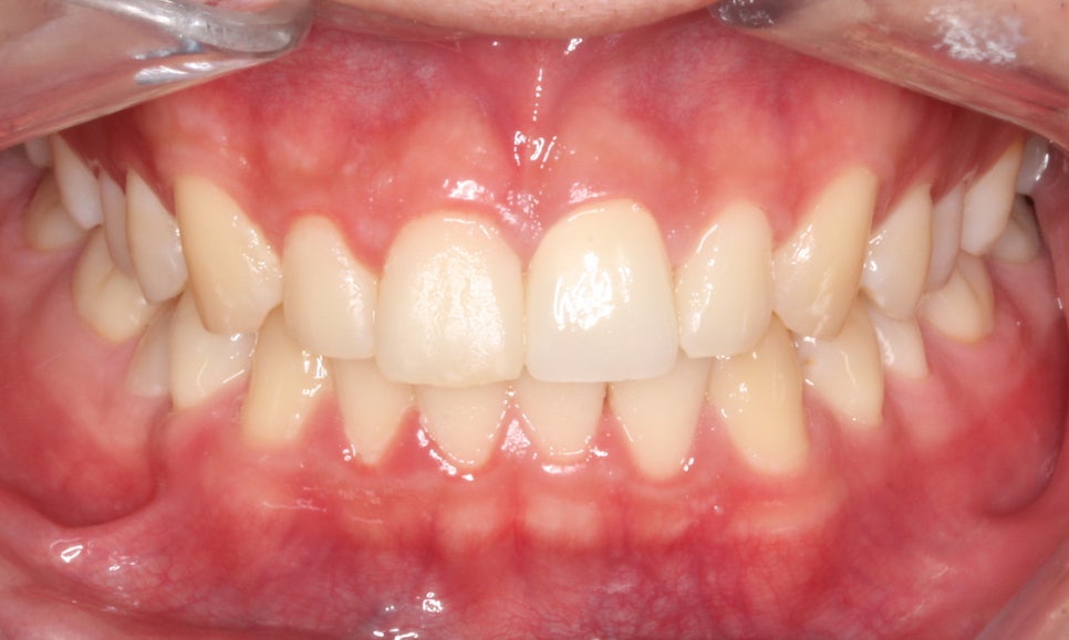 2D(투디)치과 블링스, 추천합니다!(깨진 앞니, 돌출앞니, 벌어진 앞니, 치아 노후, 치아 변색) 관련 이미지 9