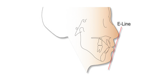 돌출입 유형 및 증상, 치과 내원 전 자가진단! 관련 이미지 1