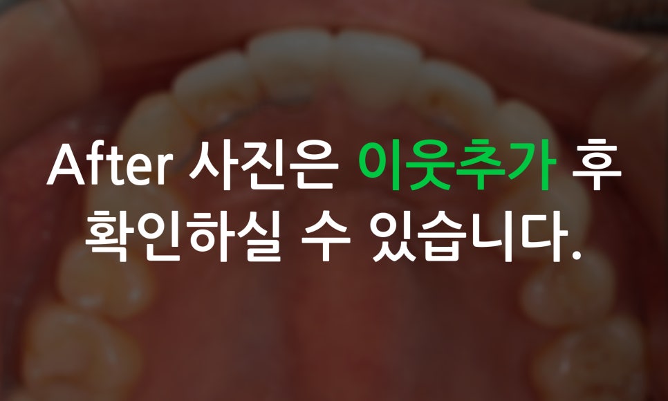 토끼앞니교정, PFM크라운 재보철을 동시에 치료하는 방법? 관련 이미지 10