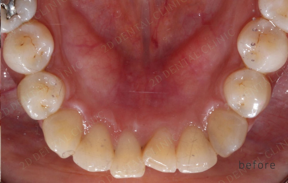 2D치과(투디치과) 교정일기ㅣ앞니덧니,반대교합 치아교정 완료!(ft.투디교정 전체교정) 관련 이미지 10