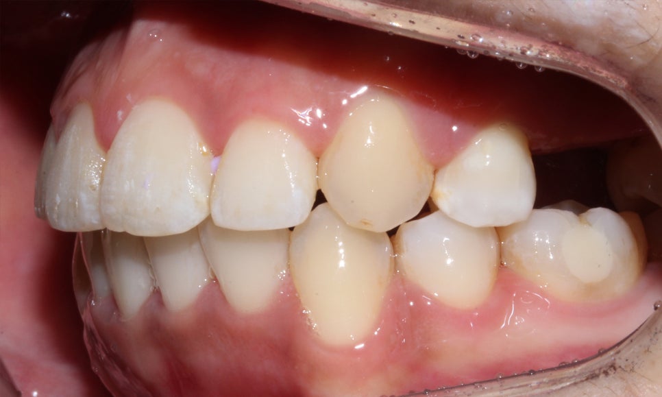 crowding 송곳니덧니 세라믹교정 방법 관련 이미지 12