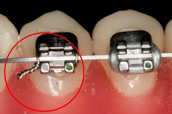 2D교정? 클리피씨? 자가결찰 브라켓! 강남 투디치과 관련 이미지 4