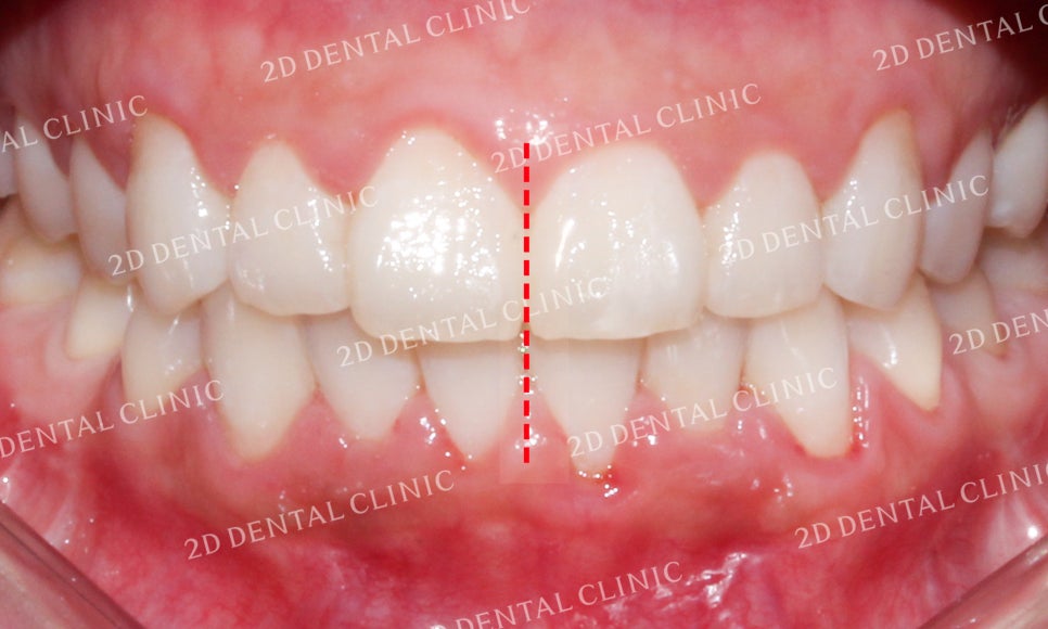 [투디교정] 덧니치아교정, 부분교정으로 쉽고 빠르게! by.투디치과(2D치과) 관련 이미지 14