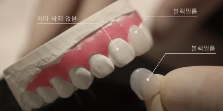 앞니왜소치 치아깨짐 무삭제라미네이트 블랙필름 관련 이미지 6