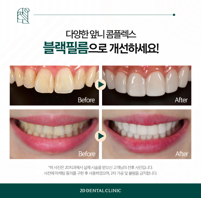 무삭제라미네이트가격 토끼 앞니도 개선이 되나요? 관련 이미지 6