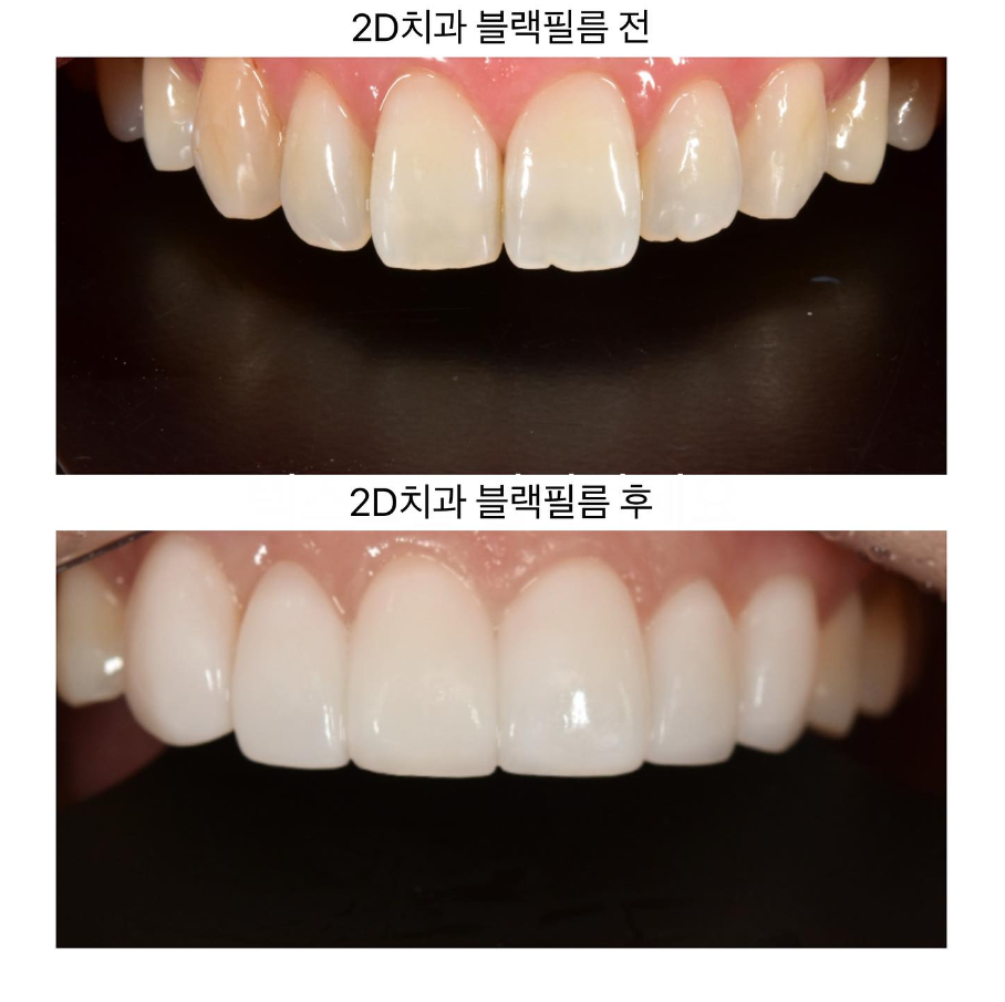 누런니 미백효과있는 무삭제라미네이트 블랙필름 관련 이미지 4