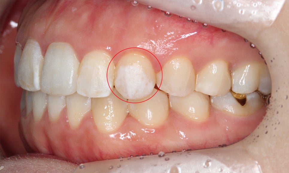 양악교정 송곳니교정 중심으로 관련 이미지 13