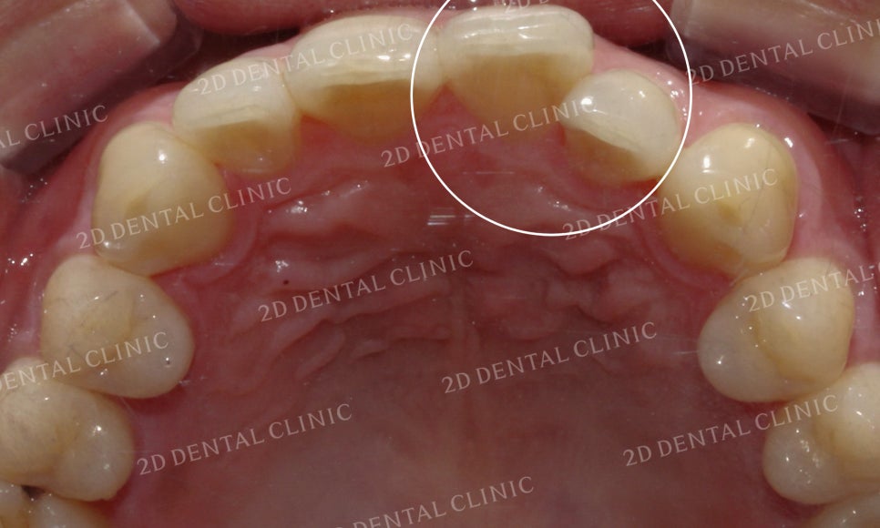 틀어진 앞니를 전체 교정으로 바르게! by.투디치과(2D치과) 관련 이미지 6