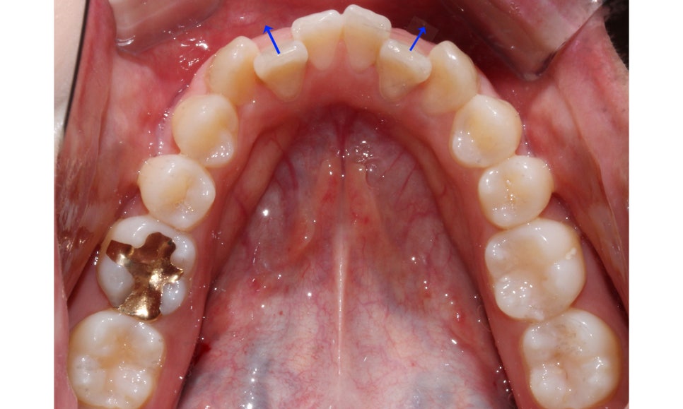 역삼역치과 송곳니덧니 crowding Case 관련 이미지 7