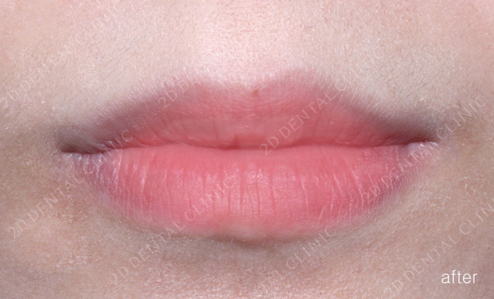 토끼이빨 치아교정 치료 사례 관련 이미지 8