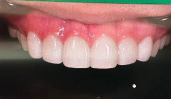 무삭제 라미네이트후기 살펴보기 관련 이미지 2