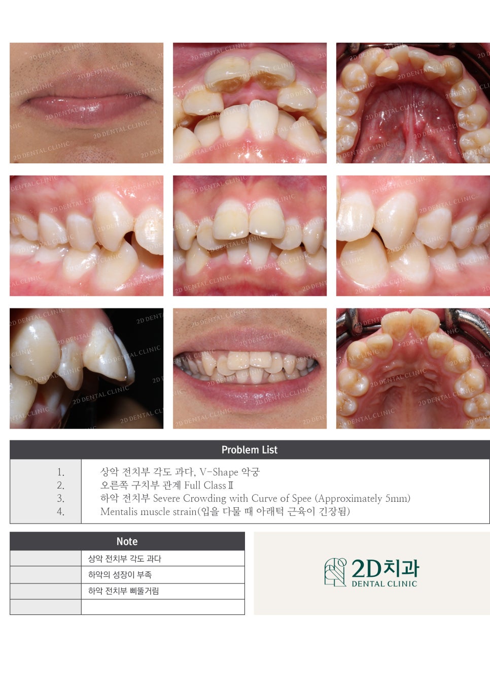 돌출앞니 교정, 튀어나온 입을 넣어보자! by.투디치과(2D치과) 관련 이미지 11