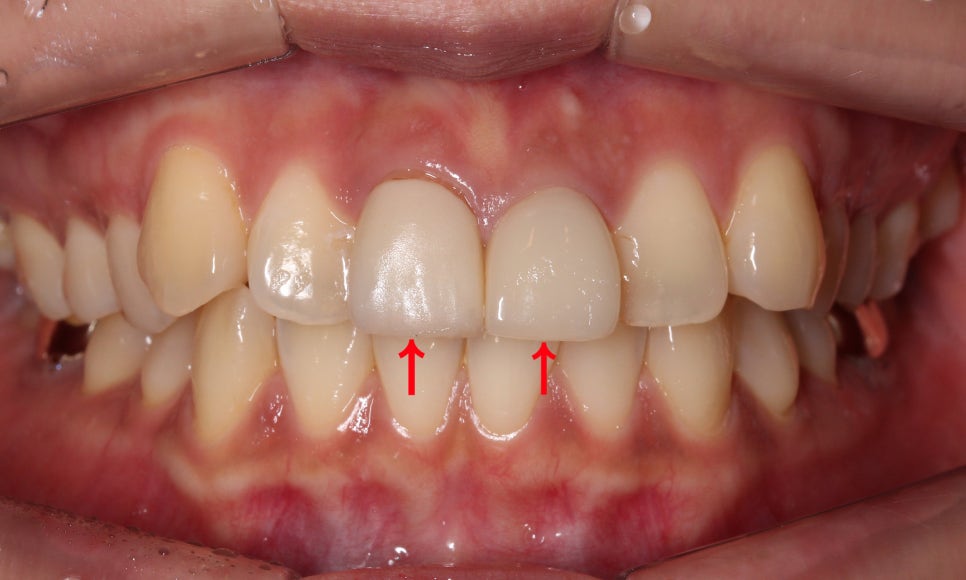 토끼앞니교정, PFM크라운 재보철을 동시에 치료하는 방법? 관련 이미지 1