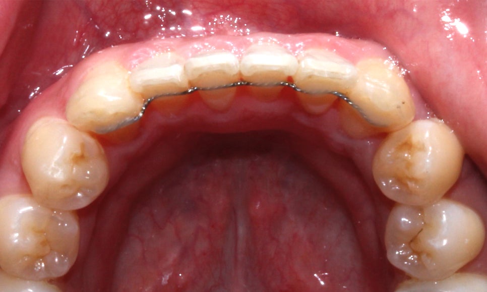 뻐드렁니 교정, 강남역치과에서 앞니 부분 교정한 후기! 관련 이미지 13
