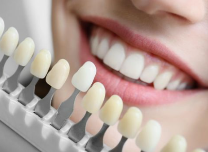 치아성형은 치아삭제 없는 무삭제 라미네이트 블랙필름 관련 이미지 2