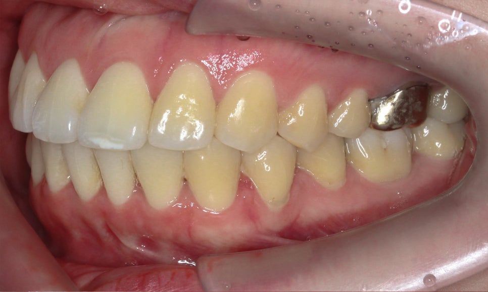 입툭튀 교정 신논현역치과 전체교정으로 관련 이미지 12