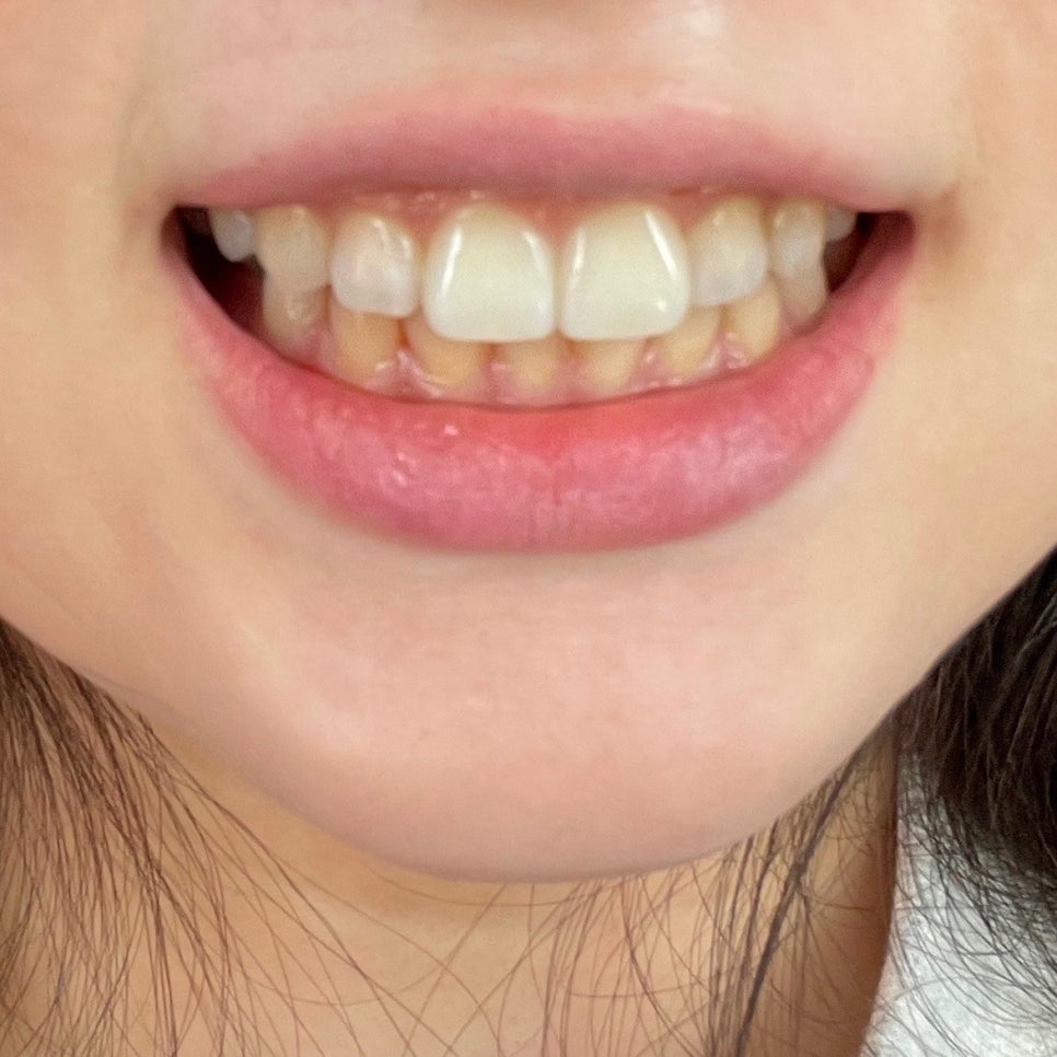 무삭제라미네이트후기 많은 고객님들의 찐후기가 많은 2D치과 관련 이미지 5