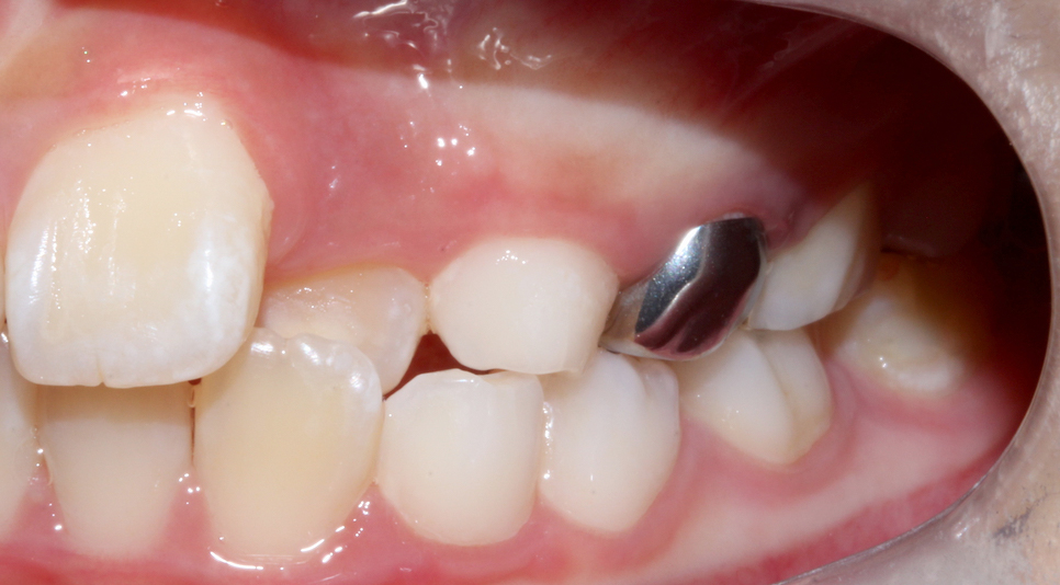 (2D)투디치과: 성장기 어린이 비발치 부정교합 후기 과정. 관련 이미지 4