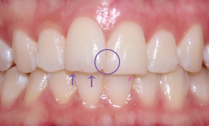 [신논현역치과] 앞니돌출 2D교정으로 개선! 관련 이미지 4