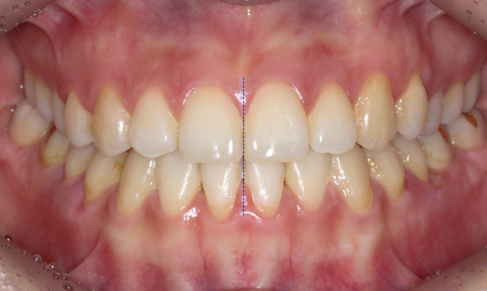 절단교합 클리피씨 교정 방법 관련 이미지 8