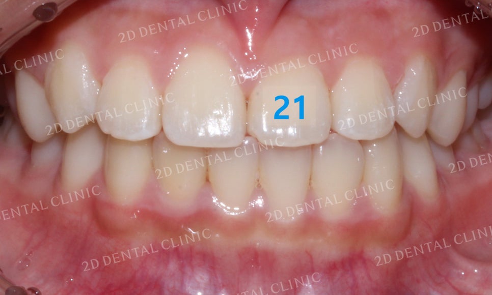 반대교합 치아교정, 앞니를 가지런하게! by.투디치과(2D치과) 관련 이미지 14