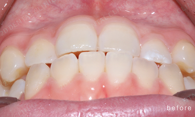 우디의 교정 일기ㅣ부정 교합 치아교정 후기 관련 이미지 5