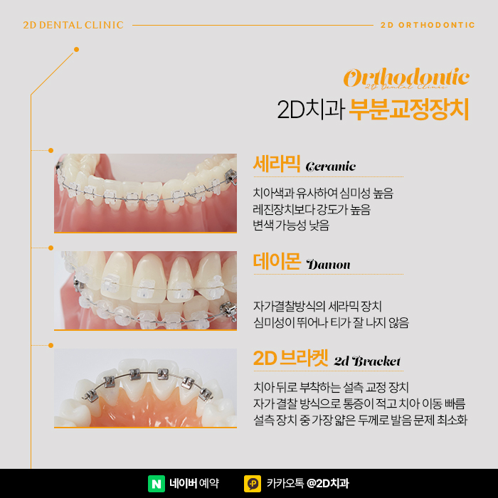 치아교정기간 단축시키기 위한 방법? 신논현 앞니부분교정 관련 이미지 6