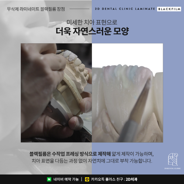 치아 삭제 없는 앞니 무삭제 라미네이트 <블랙필름> 관련 이미지 5