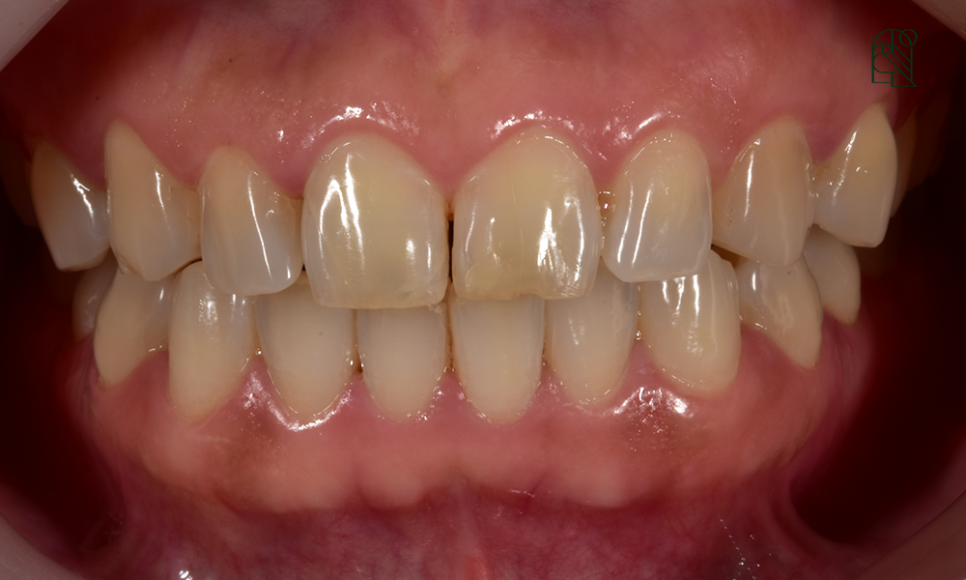 벌어진 앞니, 앞니벌어짐(diastema) 치료 - 레진, 교정, 라미네이트 관련 이미지 10