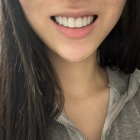 부분 라미네이트 치아 심미치료는 무삭제로 진행가능한 블랙필름 관련 이미지 7