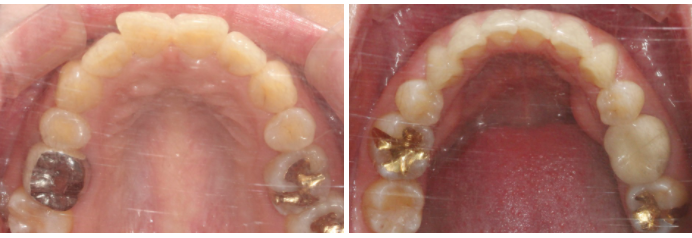 토끼앞니교정 부분교정으로 단기완성 관련 이미지 6