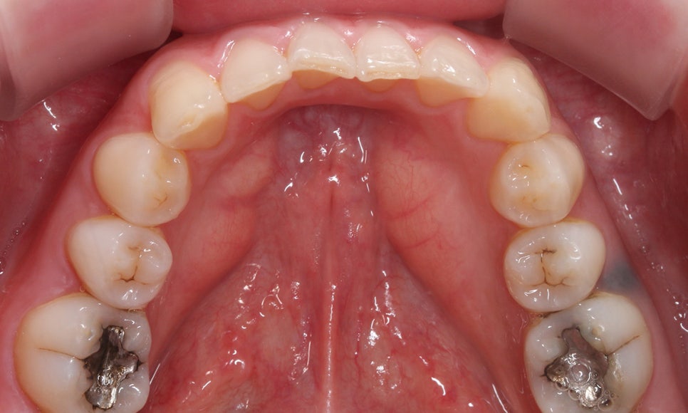 덧니교정 2D교정 (부분교정) 후기 관련 이미지 6